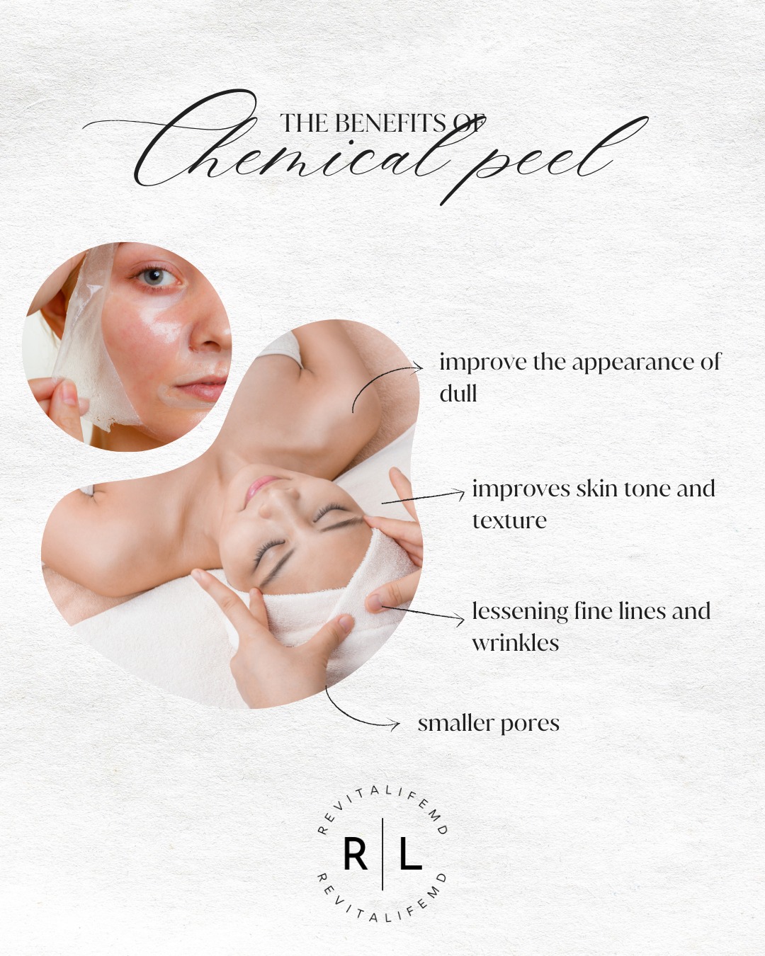 Chemical Peel Louisville KY