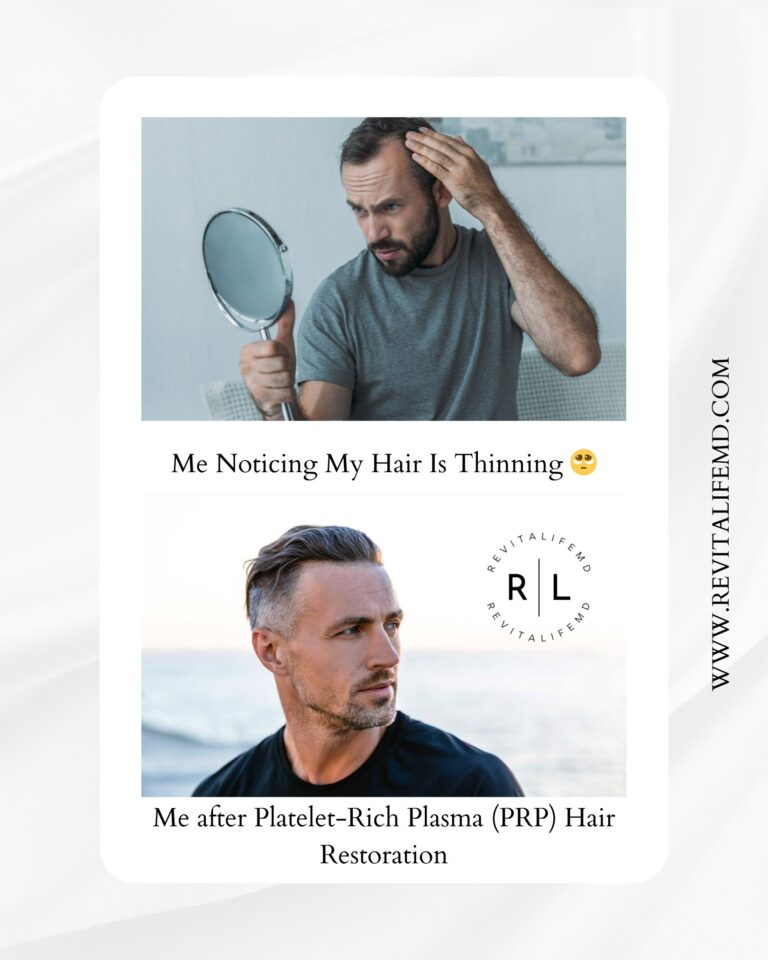 Platelet-Rich Plasma (PRP) hair restoration