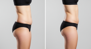 emsculpt neo before and after
