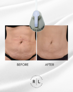 Before and after EMSculpt Neo