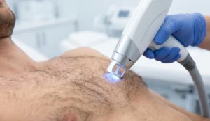 laser hair removal for men